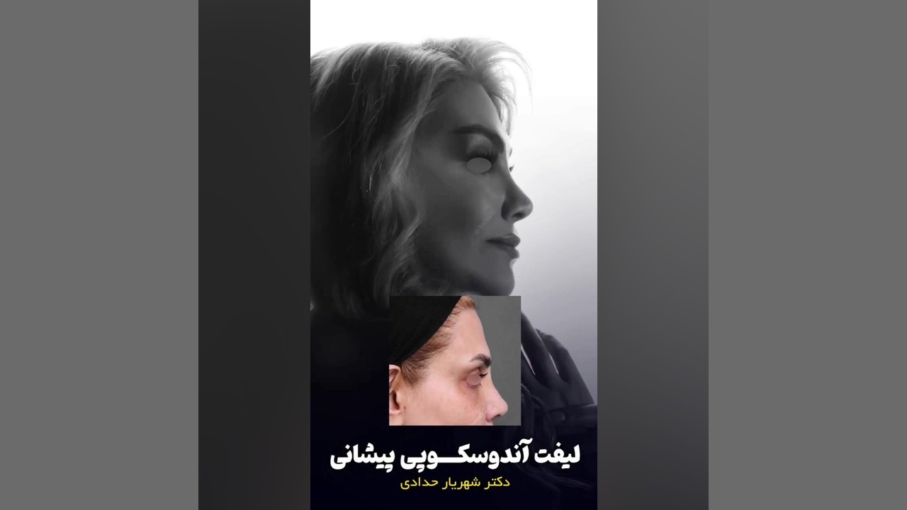 لیفت آندوسکوپی پیشانی | دکتر شهریار حدادی کلونینگ درمانی