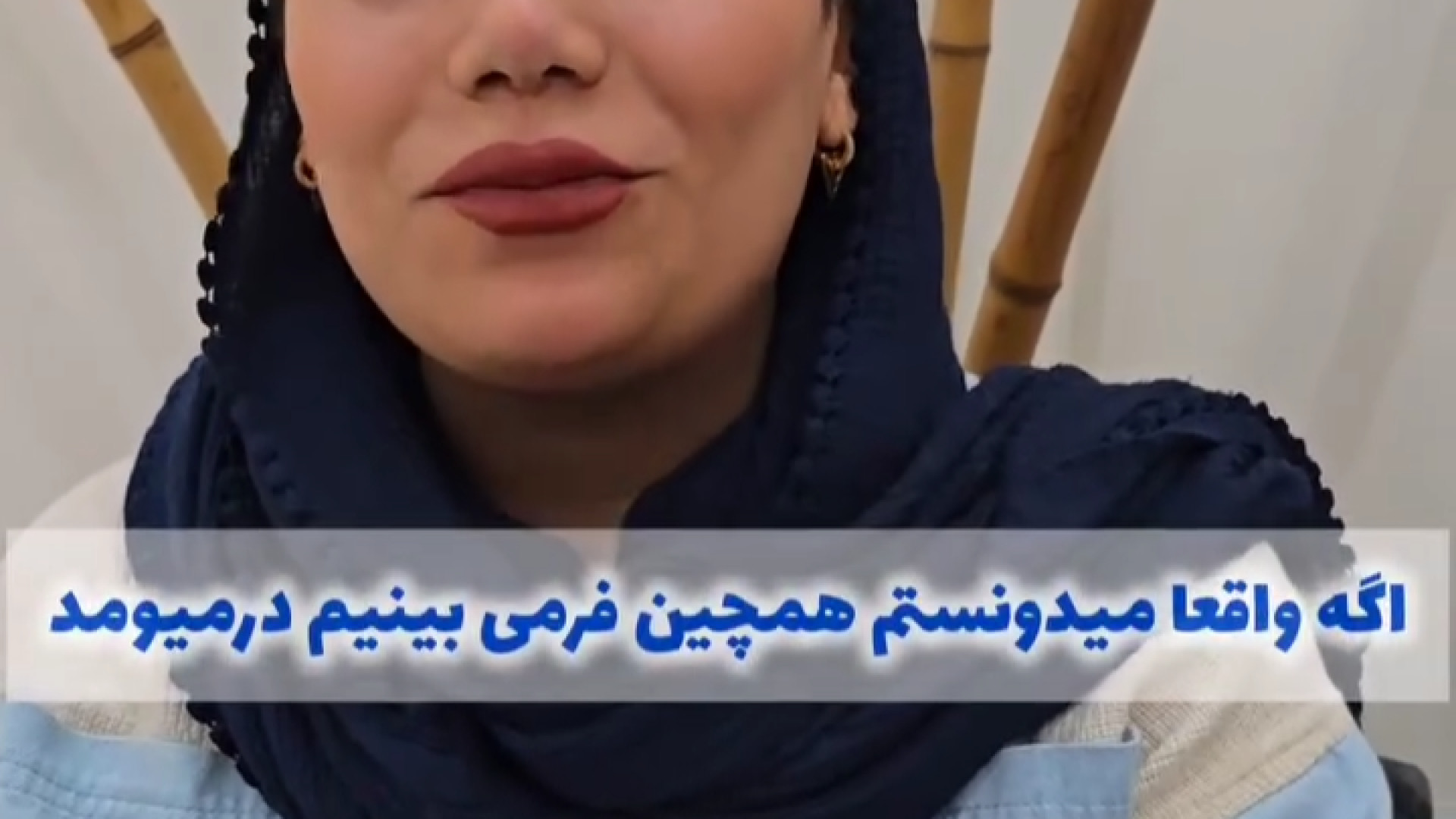 نمونه عمل بینی توسط دکتر محسن فضلی موچوله