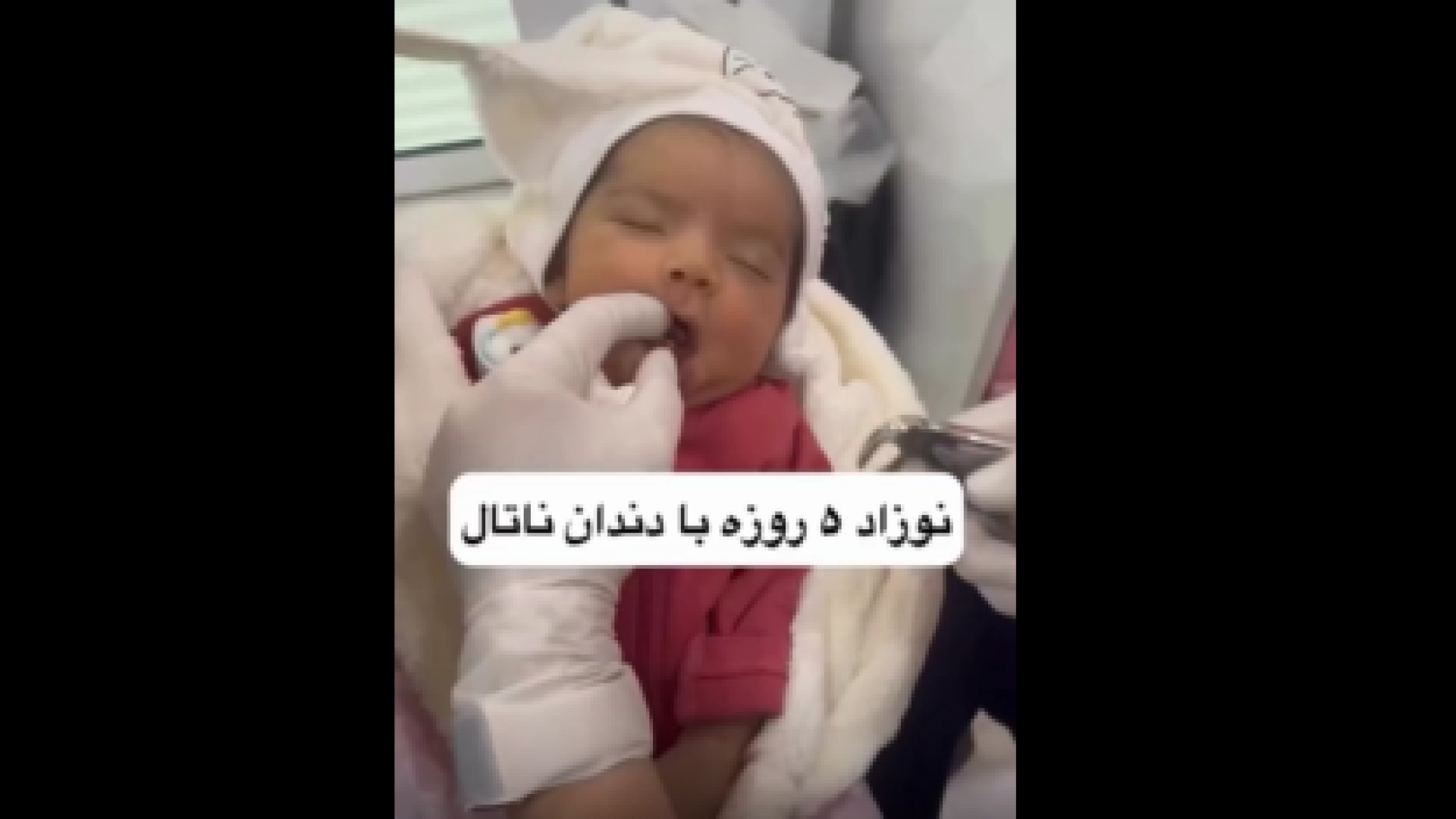 نوزاد ۵ روزه با دو دندان ناتال آریانا گرانده