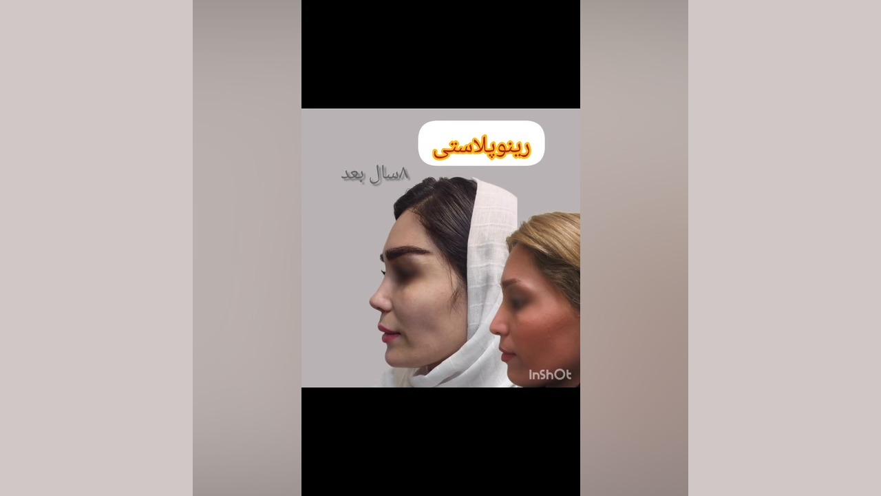 نتیجه رینوپلاستی محبوب دکتر محمودرضا اصحاب یمین - فوق تخصص پلاستیک