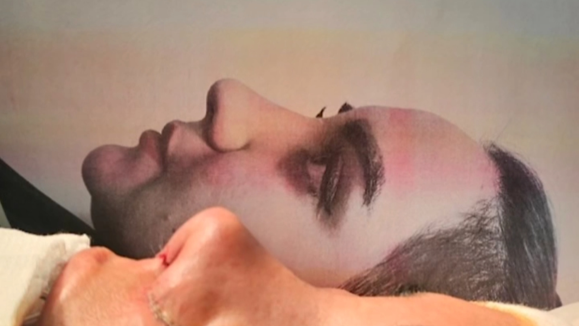 بلافاصله بعد از جراحی زیبایی بینی دکتر محمودرضا اصحاب یمین - فوق تخصص پلاستیک