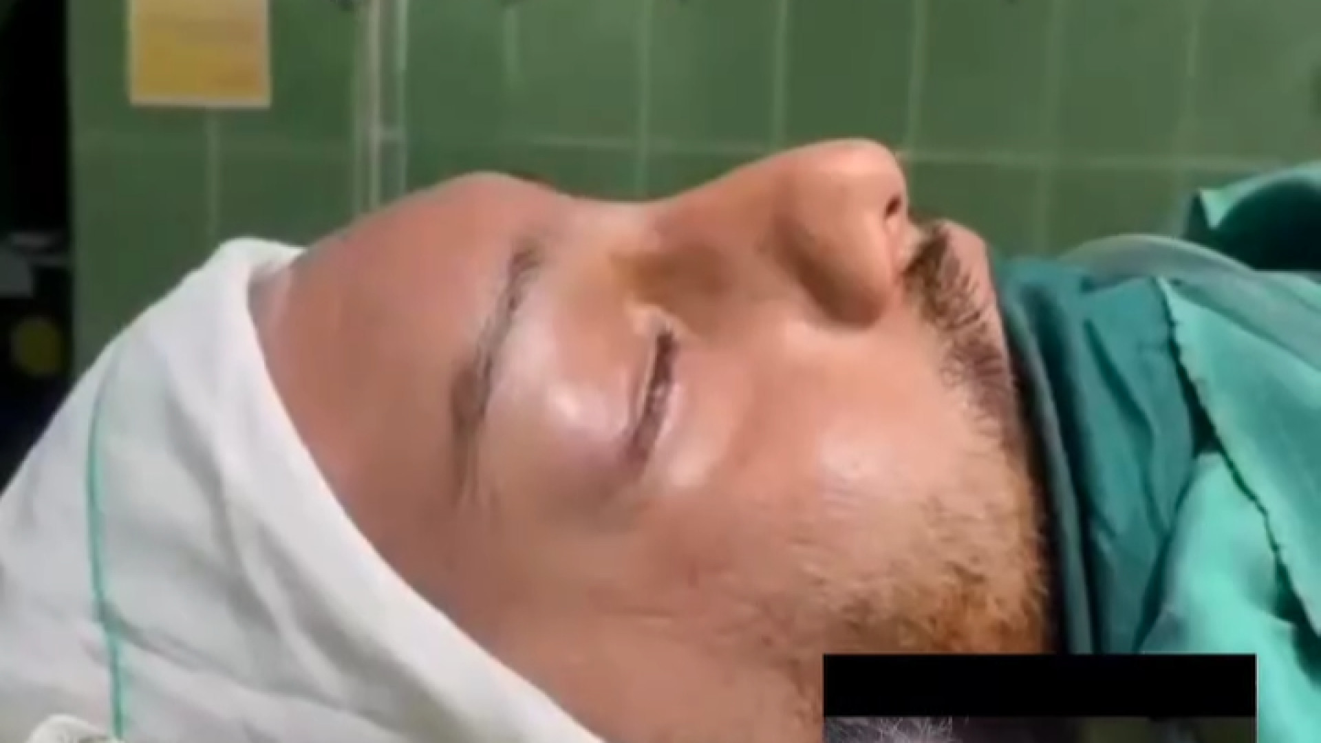 لیفت اندوسکوپ پیشانی دکتر محمودرضا اصحاب یمین - فوق تخصص پلاستیک