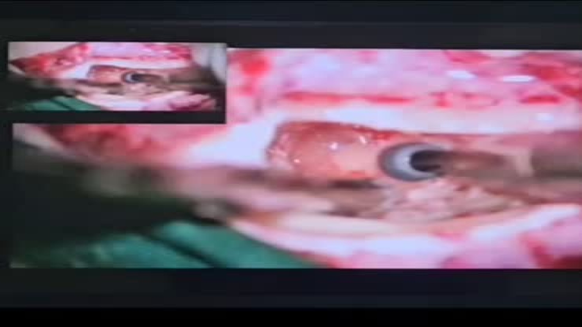 کاشت حلزون شنوایی در خانم ۳۵ ساله | دکتر زهرا عباسی هوپیلو