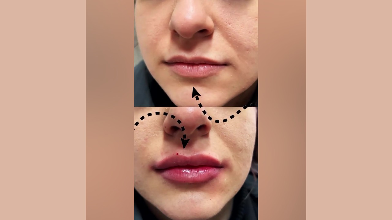 نمونه کار فیلر لب دکتر سار ا لطفی