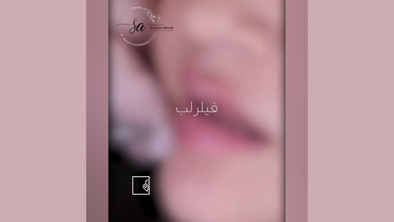آنچه که باید در مورد تزریق فیلر لب بدانید! دکتر سوسن احمدی پیر شهید