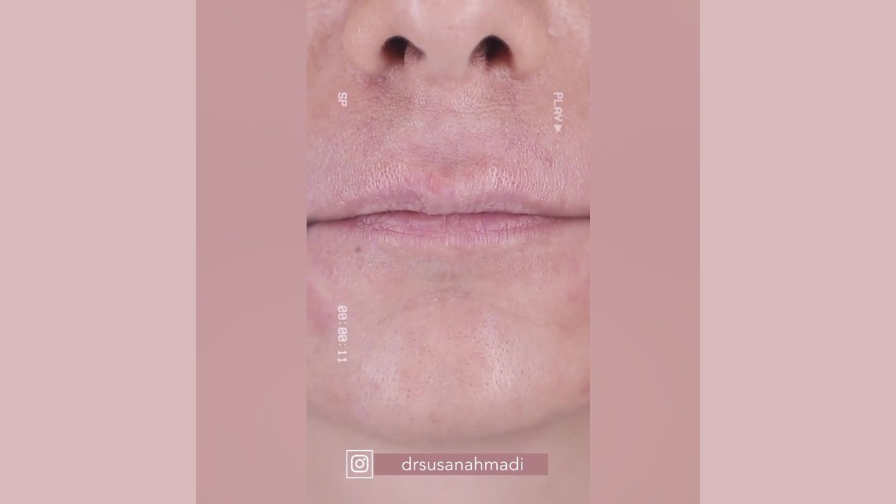تغییرات عالی یک سی سی ژل لب هنرجوی عزیز دکتر سوسن احمدی دکتر سوسن احمدی پیر شهید
