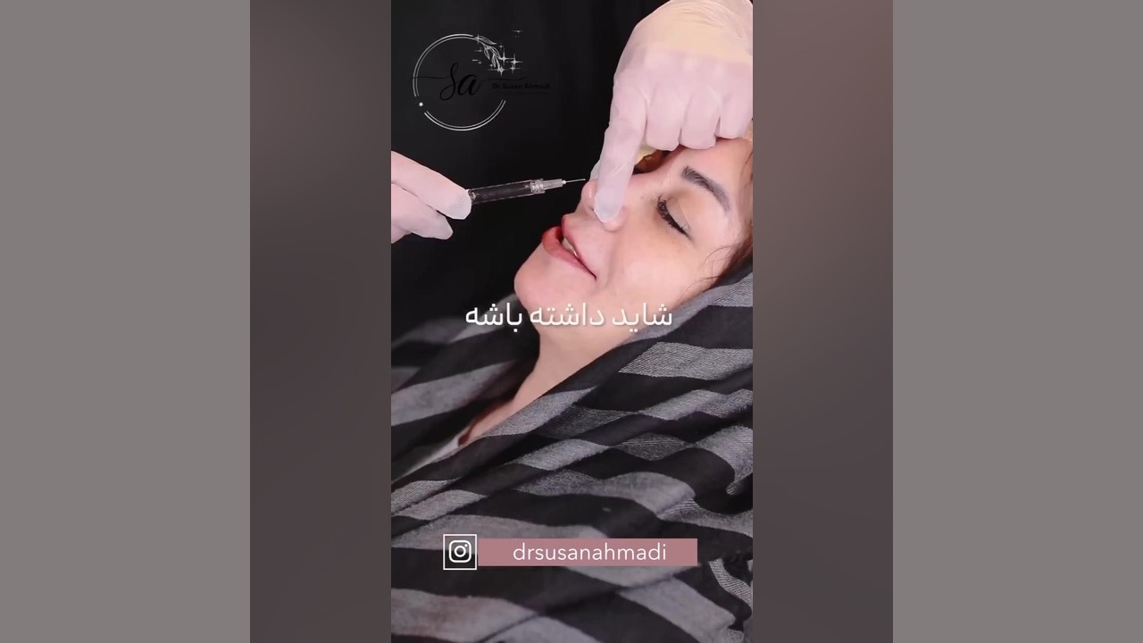 رفع نواقع بعد از عمل بینی با فیلر بینی دکتر سوسن احمدی پیر شهید
