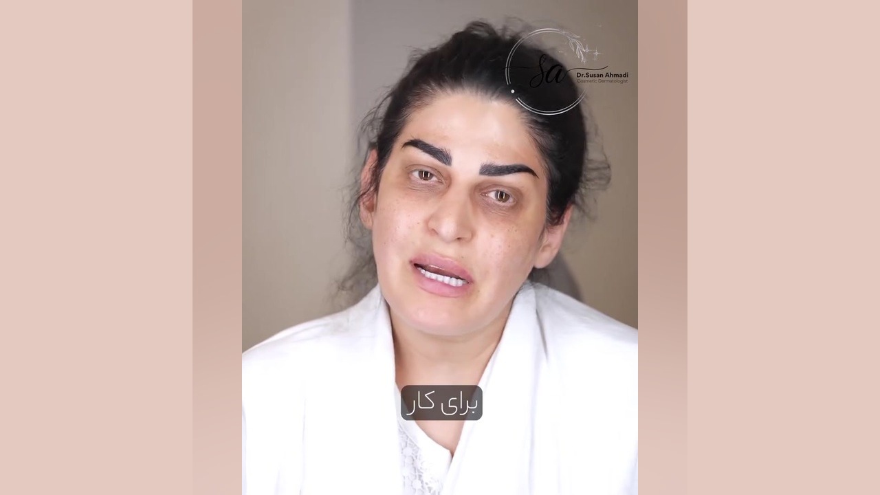 رفع تیرگی و گودی زیر چشم با فیلر | مشاوره دکتر سوسن احمدی دکتر سوسن احمدی پیر شهید