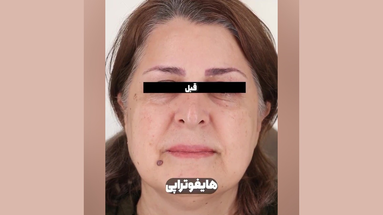 نتایج قبل و بعد هایفوتراپی صورت | مشاوره دکتر سوسن احمدی پیر شهید دکتر سوسن احمدی پیر شهید