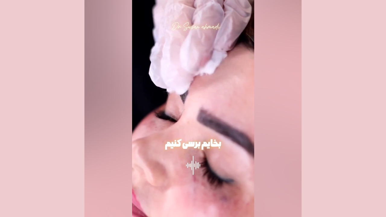 مزوتراپی ابرو: ابروهایی پرپشت و طبیعی | مشاوره دکتر سوسن احمدی دکتر سوسن احمدی پیر شهید