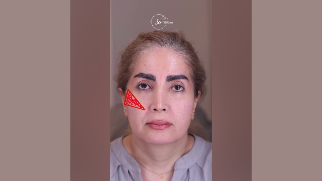تزریق چربی در یک جلسه: جوانسازی سریع و طبیعی | دکتر سوسن احمدی دکتر سوسن احمدی پیر شهید