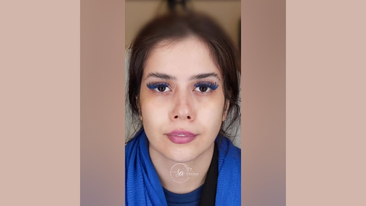 تزریق چربی صورت: بازگشت شادابی و حجم طبیعی | دکتر سوسن احمدی دکتر سوسن احمدی پیر شهید