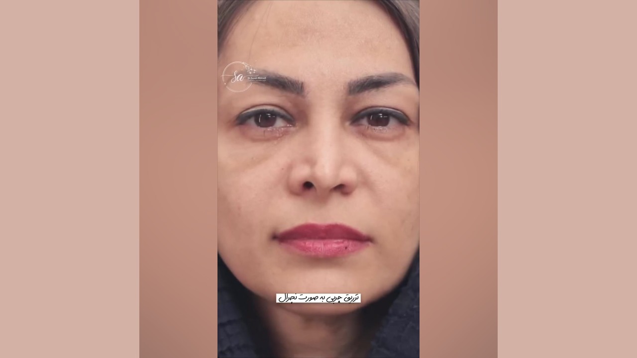 تزریق چربی نچرال: جوانسازی طبیعی صورت شما | دکتر سوسن احمدی دکتر سوسن احمدی پیر شهید