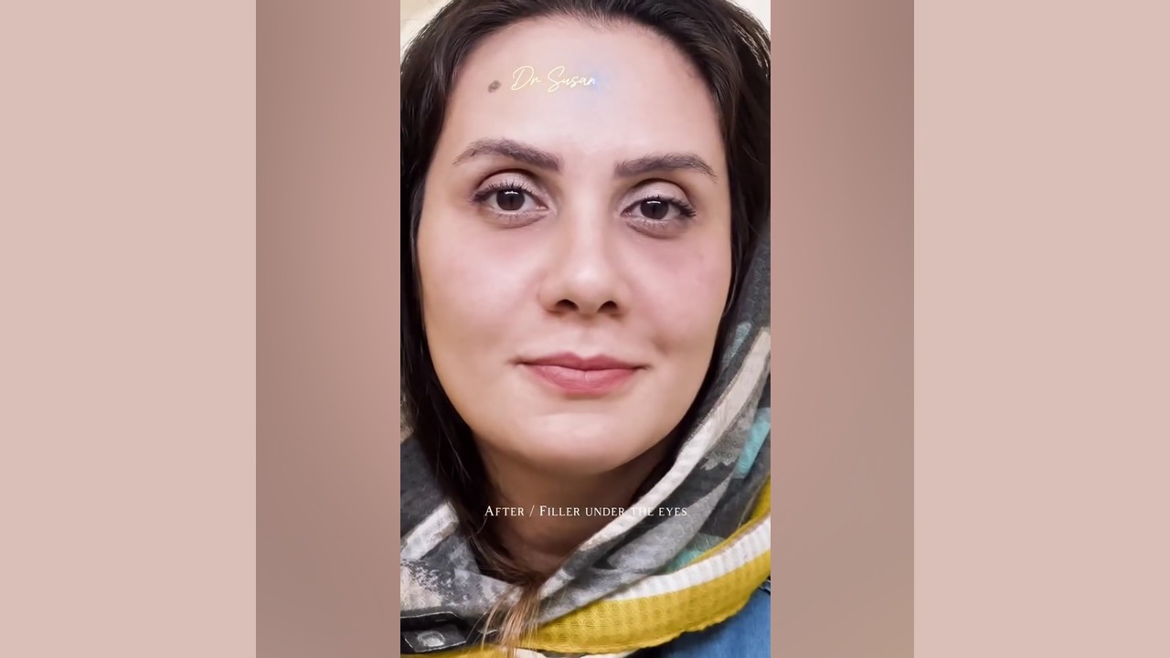 تزریق چربی کم، تغییر بزرگ در چهره | مشاوره دکتر سوسن احمدی دکتر سوسن احمدی پیر شهید