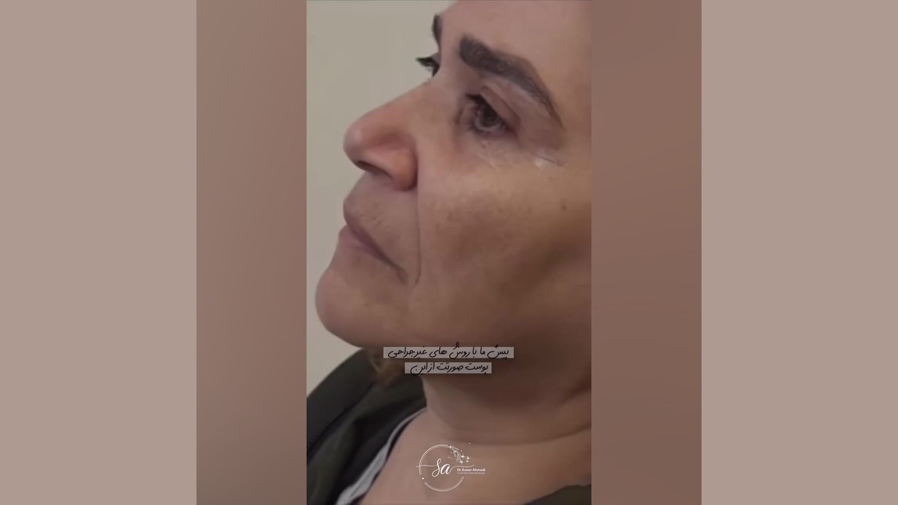 جوانسازی طبیعی صورت: بازگشت شادابی و طراوت | دکتر سوسن احمدی دکتر سوسن احمدی پیر شهید