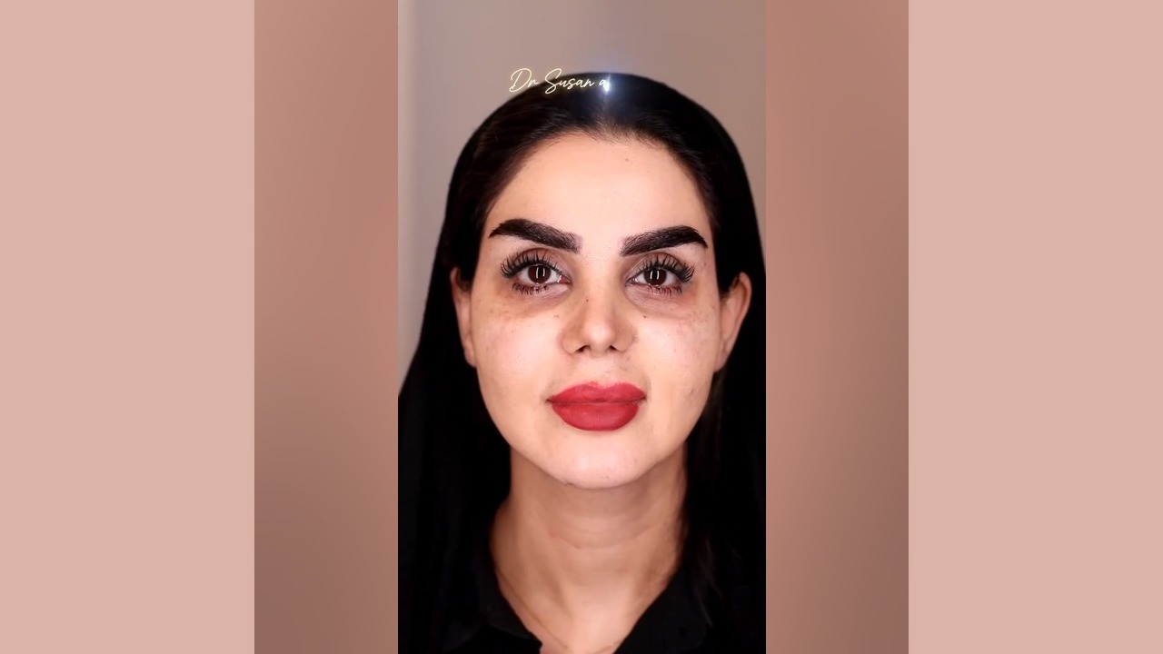 رفع تیرگی و گودی زیر چشم با تزریق چربی طبیعی | دکتر سوسن احمدی دکتر سوسن احمدی پیر شهید
