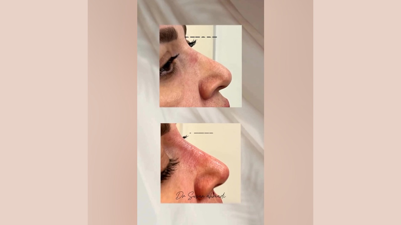 زیبایی بینی بدون جراحی با تزریق فیلر و چربی | دکتر سوسن احمدی دکتر سوسن احمدی پیر شهید