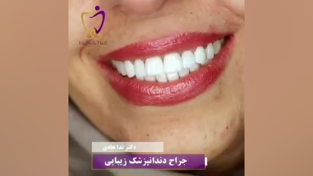 نمونه کار اصلاح طرح لبخند دکتر ندا هادی-دندانپزشک زیبایی