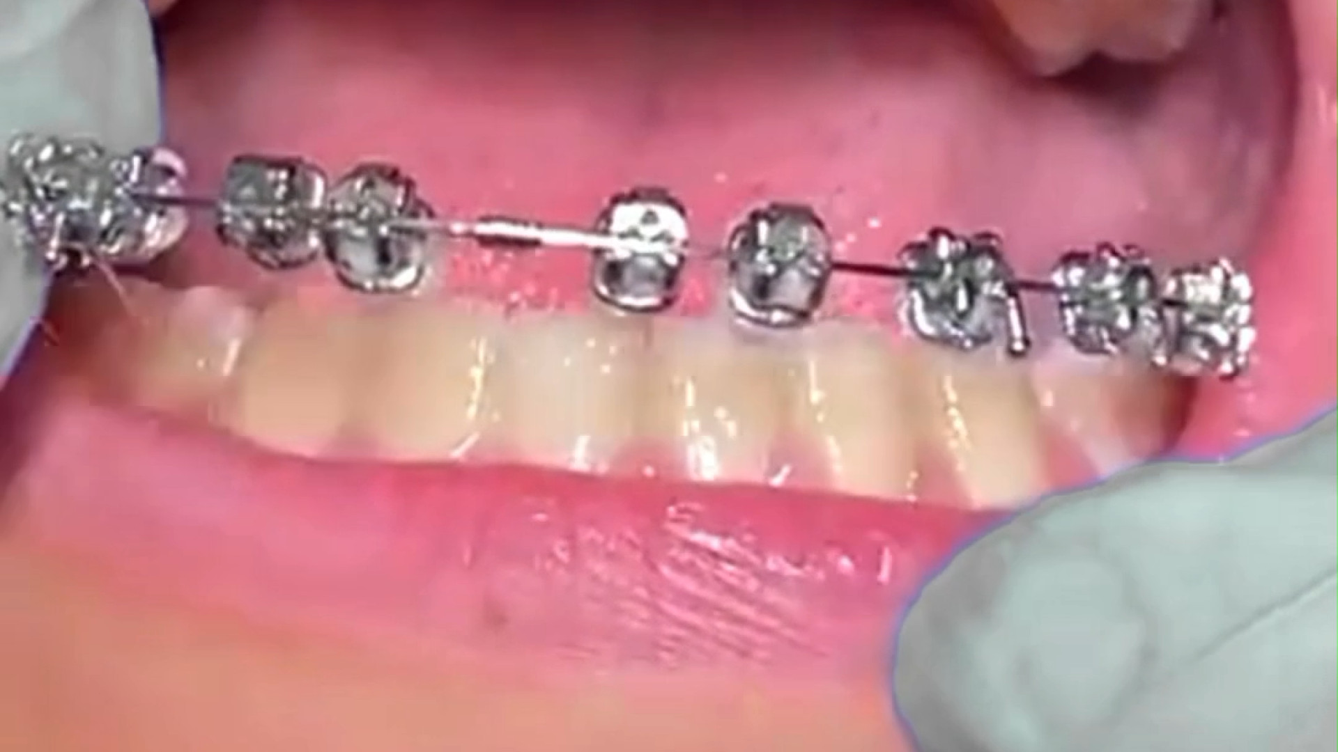 برداشتن سیم ارتودنسی از روی دندان ها / متخصص ارتودنسی / پروفسور جمیلیان دکتر عبدالرضا جمیلیان - متخصص ارتودنسی