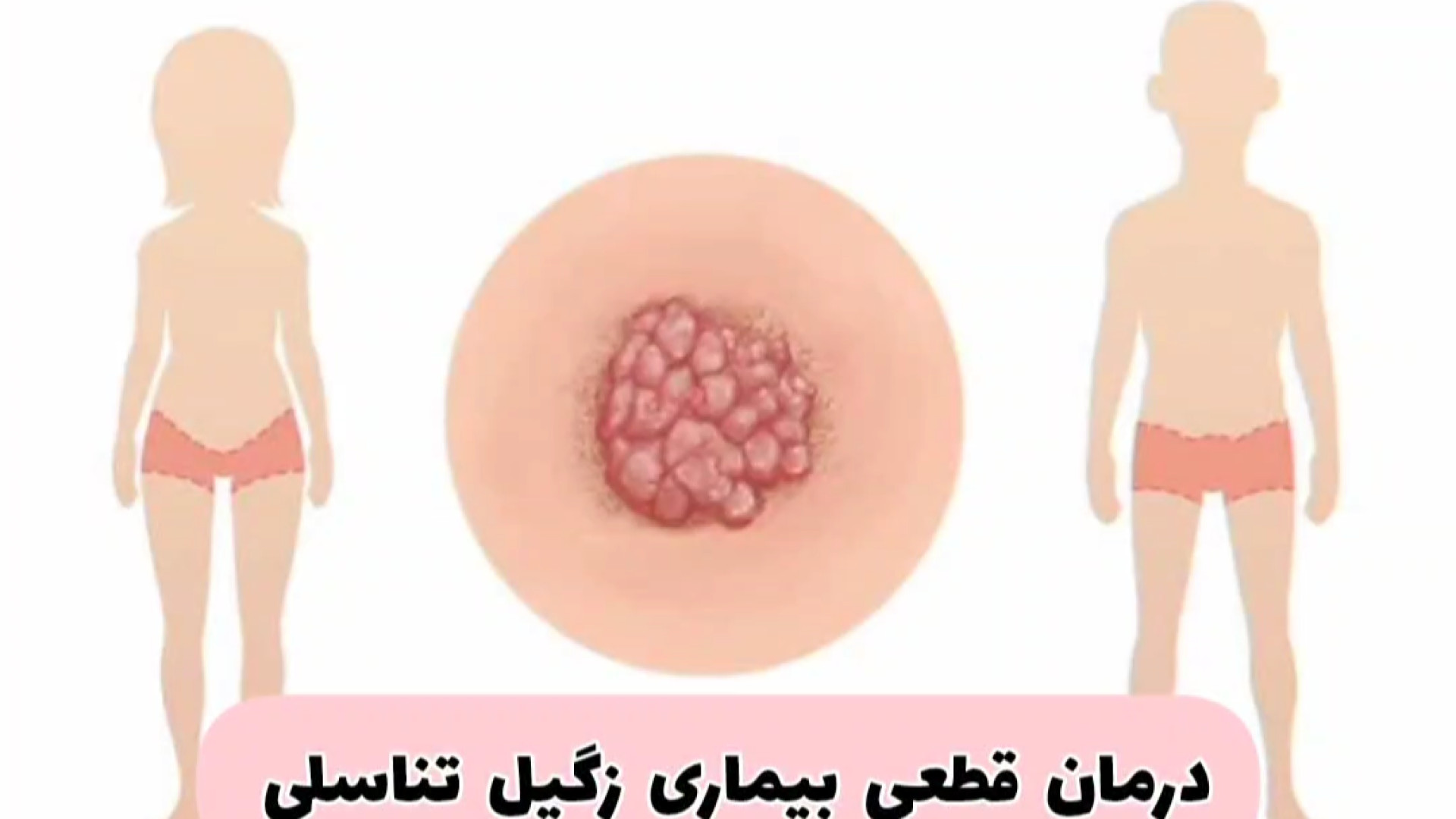 زگیل تناسلی رو درمان کن | درمان HPV بدون داروی شیمیایی با طب سنتی برداشتن زگیل