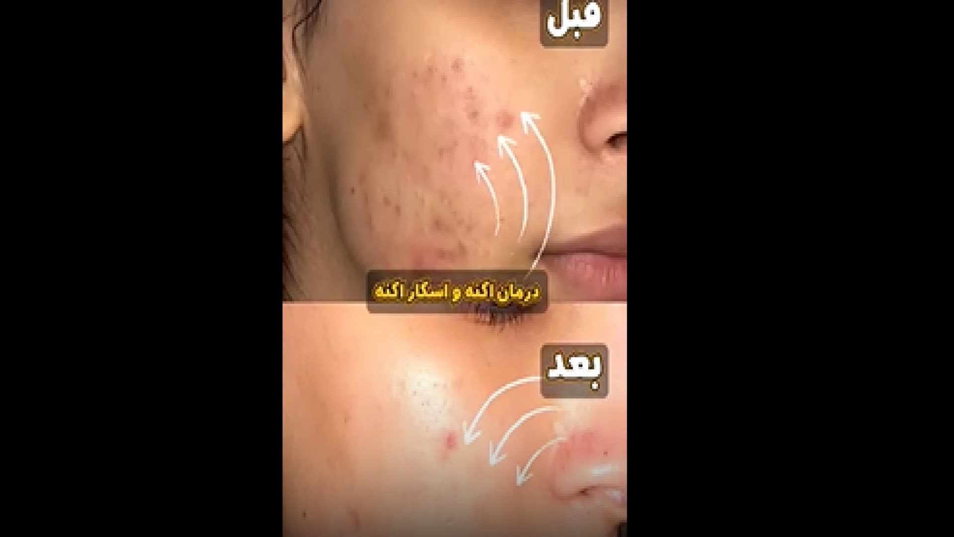 درمان جای آکنه و اسکار دکتر امیر سلیمانی