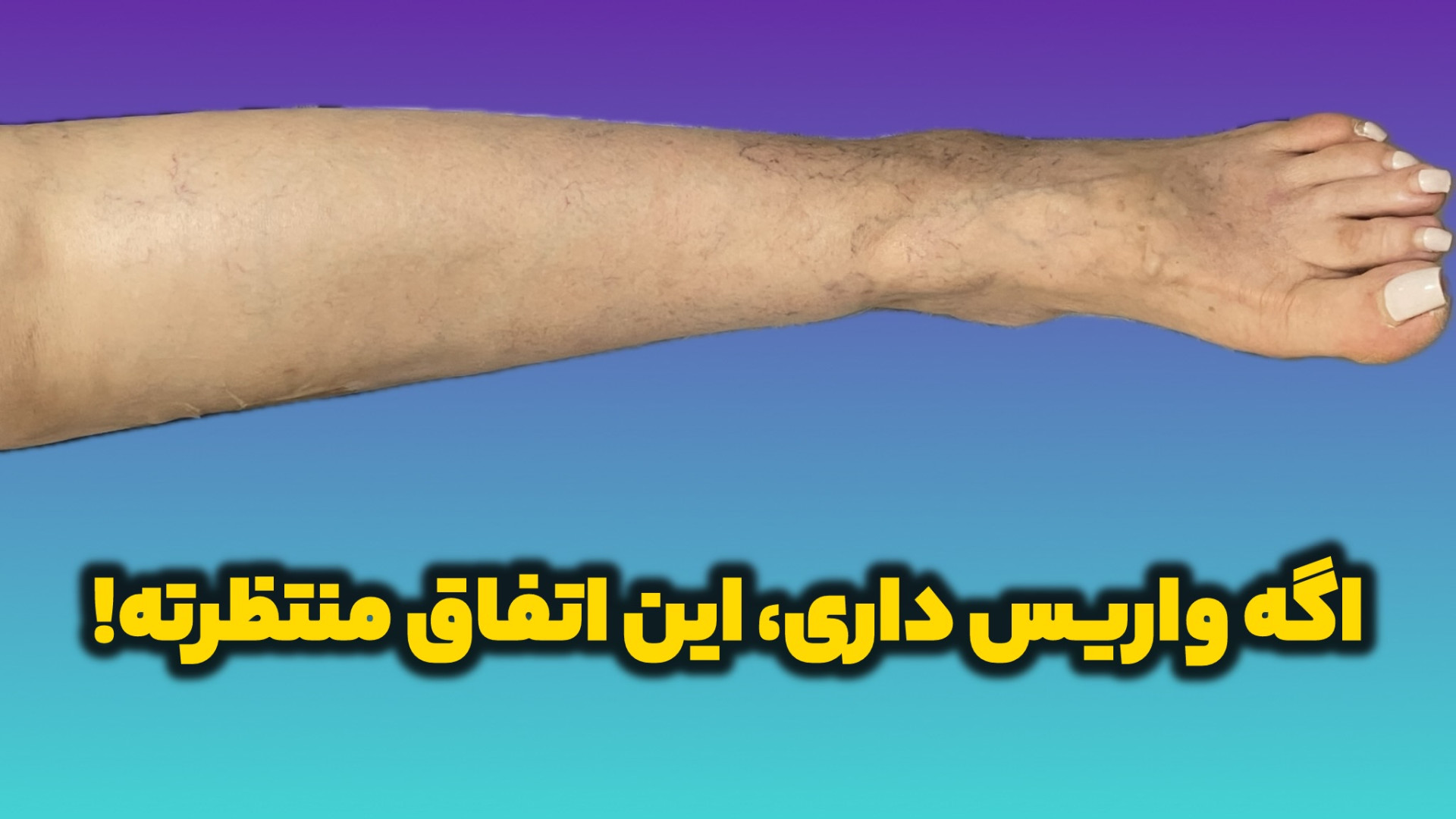 بررسی نارسایی وریدی در بیمار با واریس سطحی و ورم پا (با سونوگرافی) لیپوماتیک