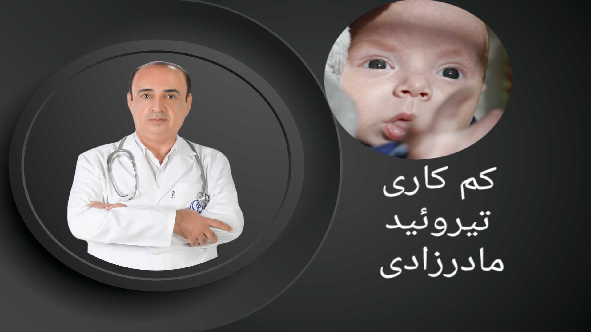 کم کاری تیروئید مادرزادی جراحی بینی