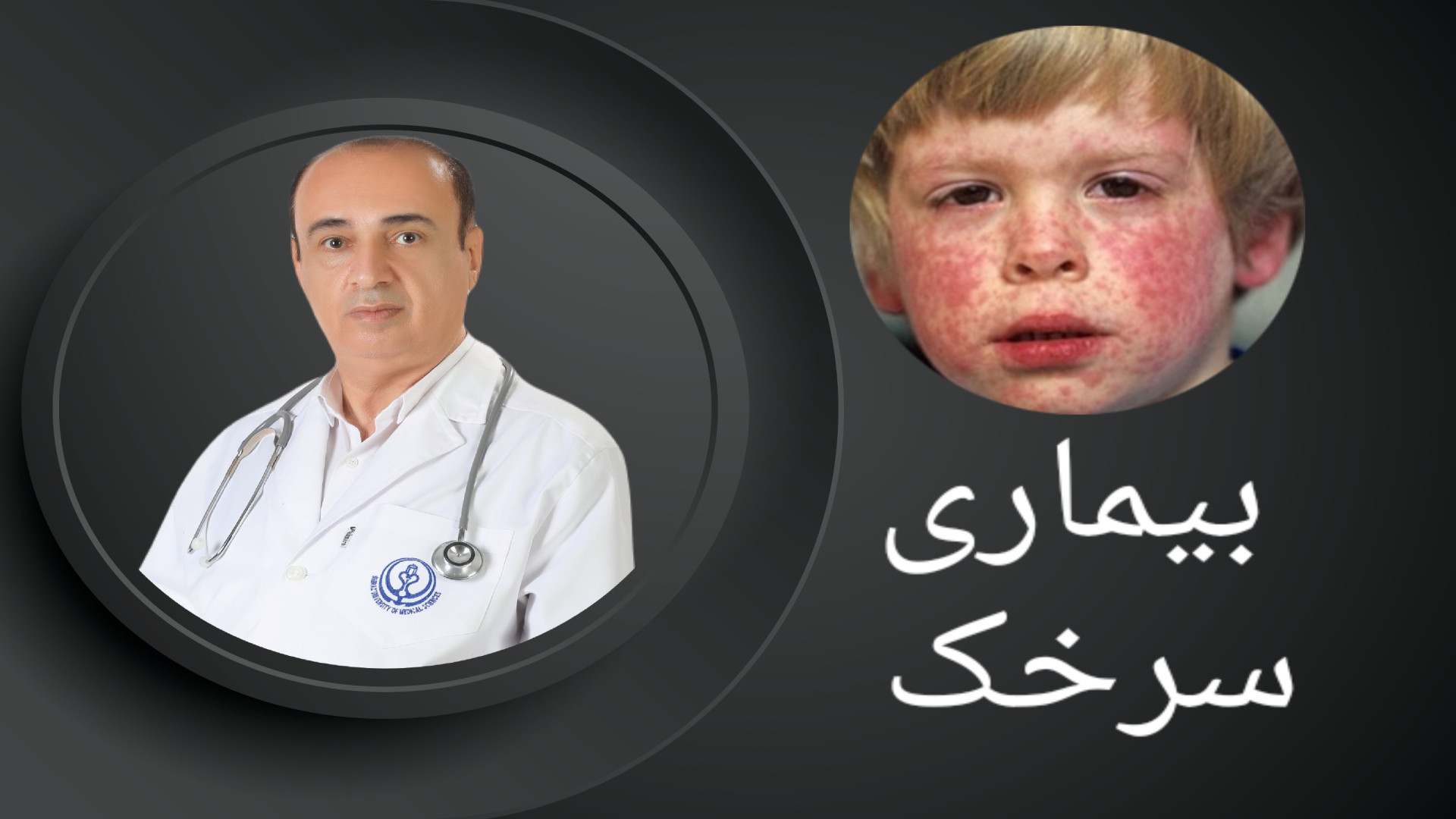 هنوز هم سرخک بیماری خطرناکی است ترمیم زیبایی دندان
