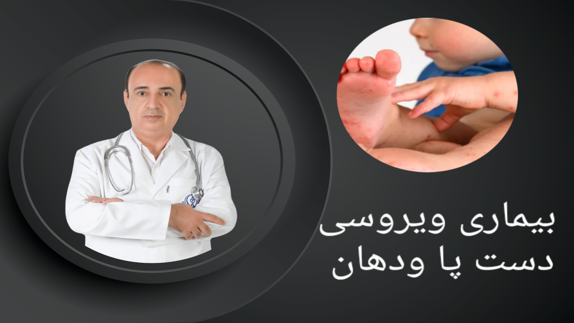 بیماری دست پا ودهان در کودکان لیفت ابرو