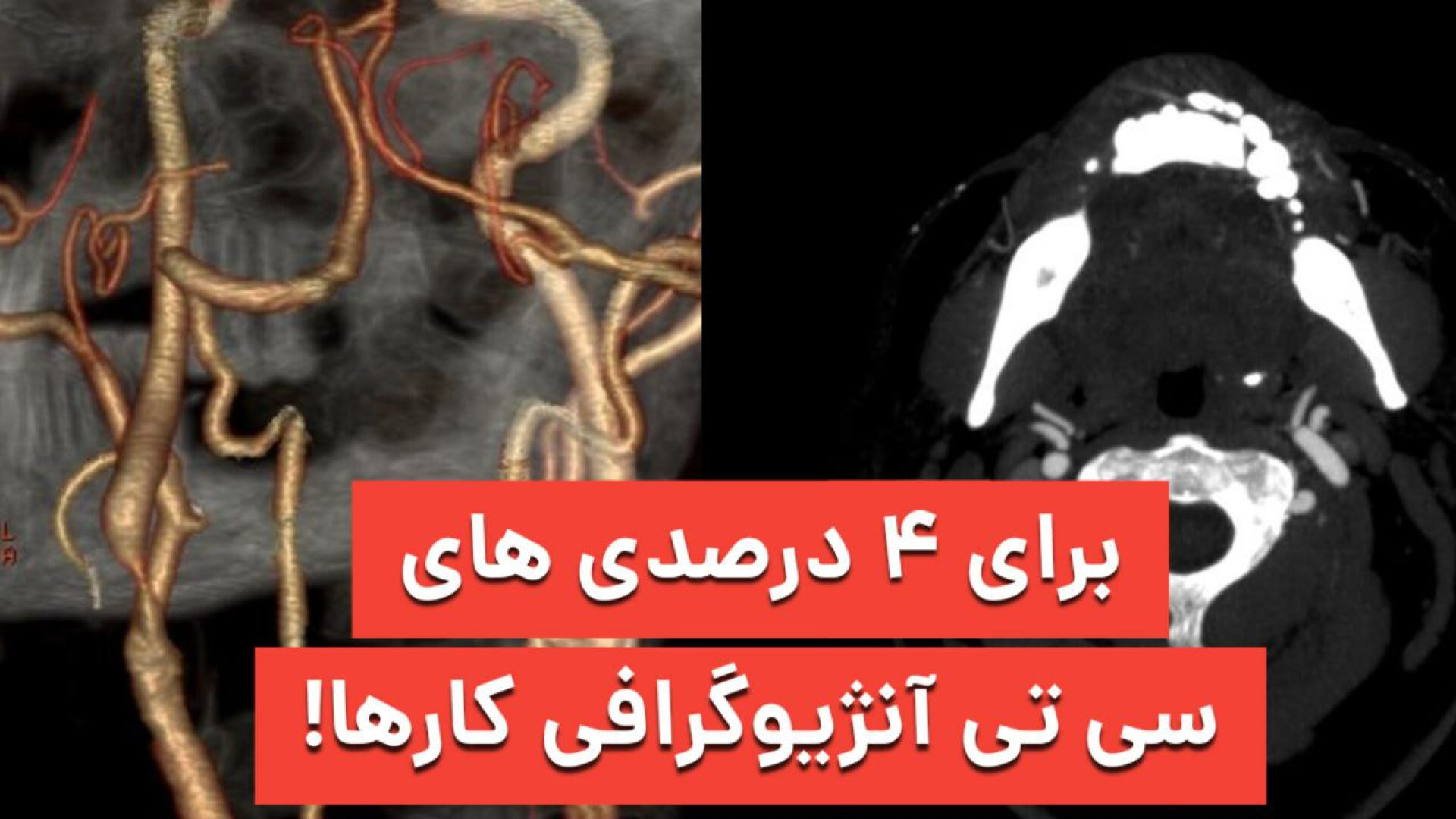تفسیر سی تی آنژیوگرافی سر و گردن پر کردن دندان