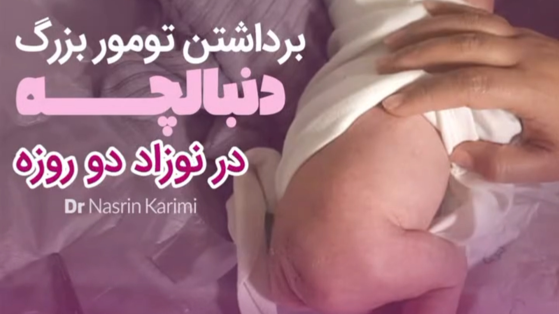جراحی موفق یک تومور بزرگ در نوزاد 2 روزه | دکتر نسرین کریمی ریحانا