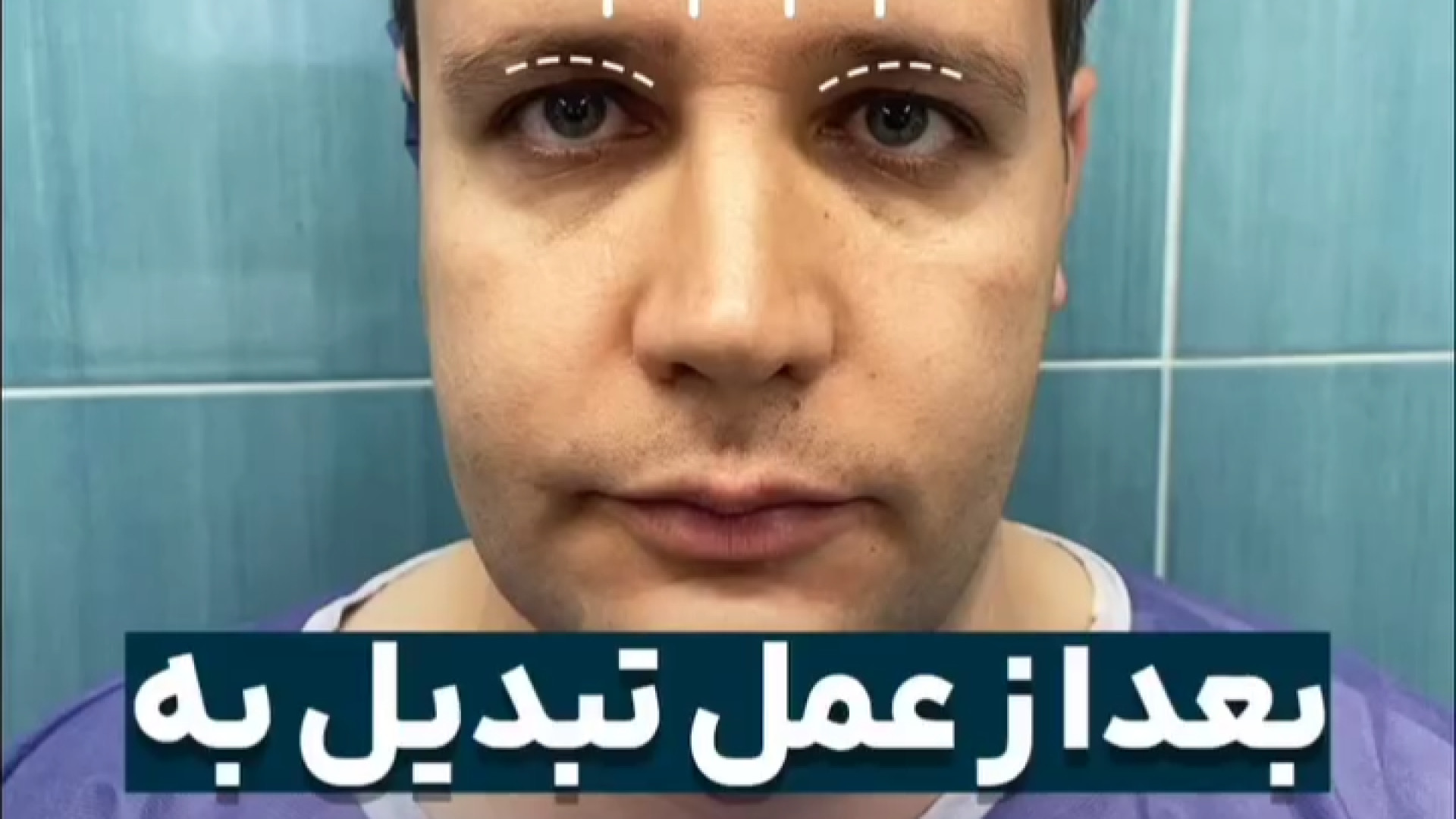 نمونه کار لیفت پیشانی موزیک قوری