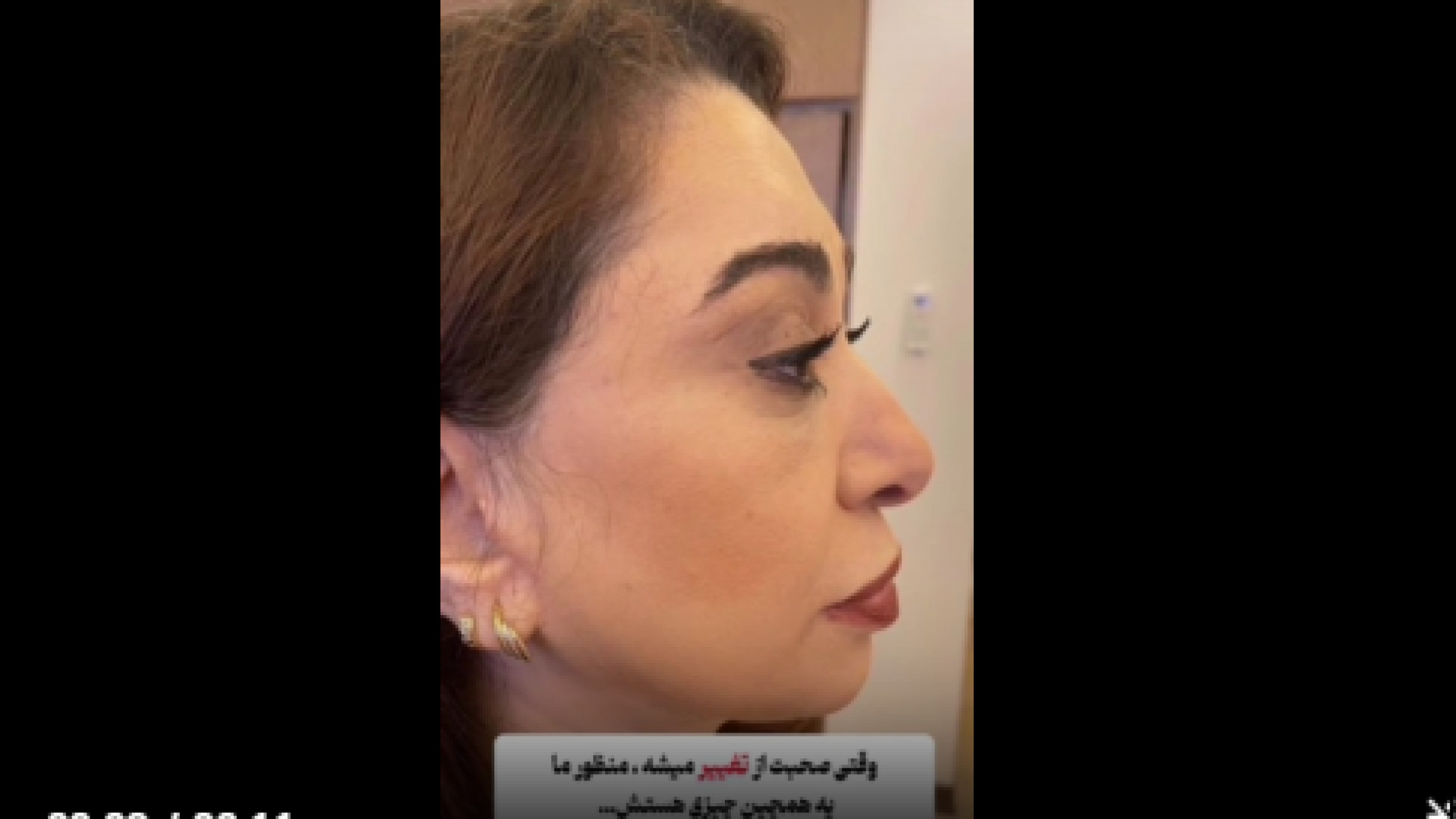 نمونه کار لیفت صورت و گردن روکش دندان