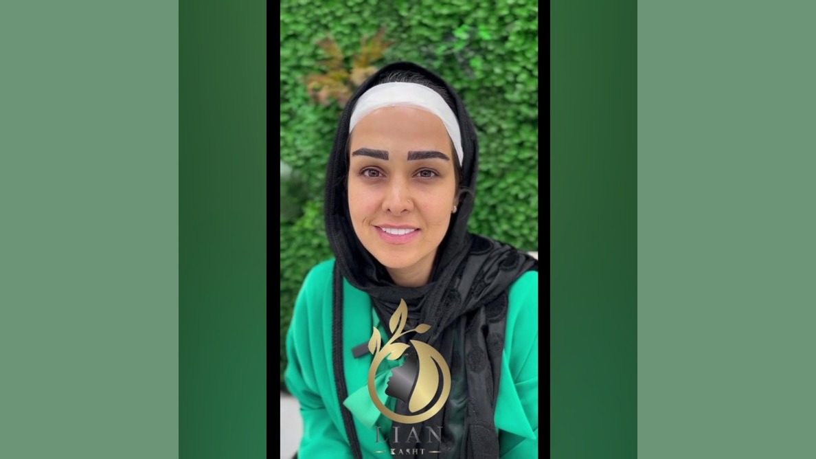 کلینیک کاشت مو و ابرو نچرال و کاملا طبیعی در شمال تهران کجاست؟ آوتوپلیسوماب
