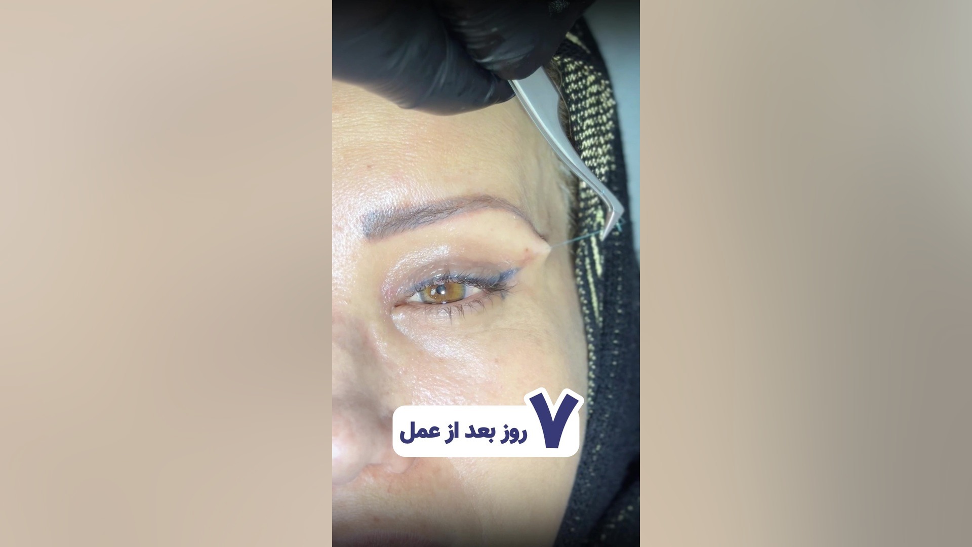 کشیدن بخیه های بلفاروپلاستی مرغ شاکردار
