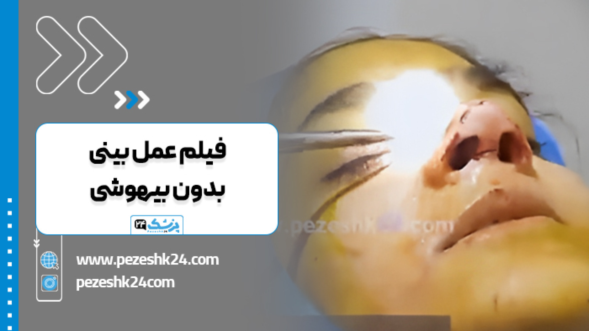 فیلم عمل جراحی بینی بدون بیهوشی | پزشک 24 ترمیم سوختگی