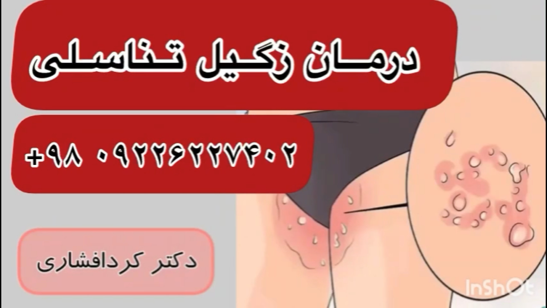 درمان زگیل تناسلی HPV در طب سنتی ایرانی | راه‌حل دکتر کردافشاری لیپوست