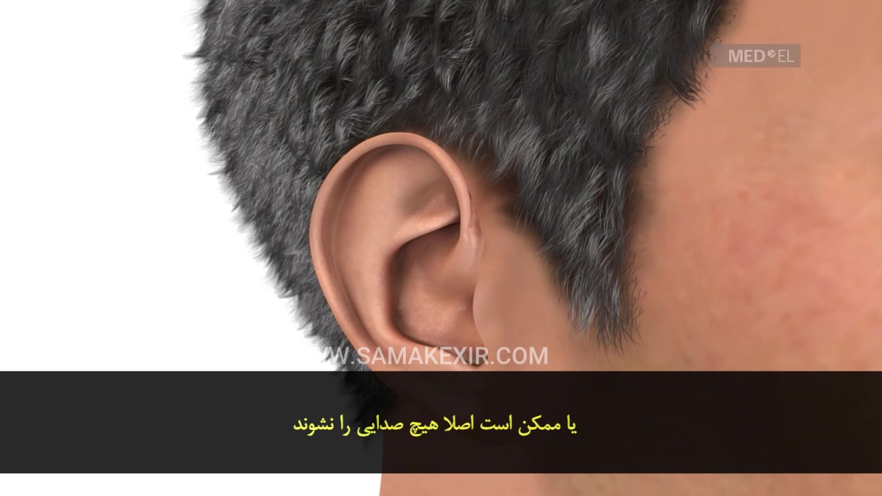 کاشت حلزون چیست؟(زیرنویس فارسی) ادیولوژیست ساجد بادفر