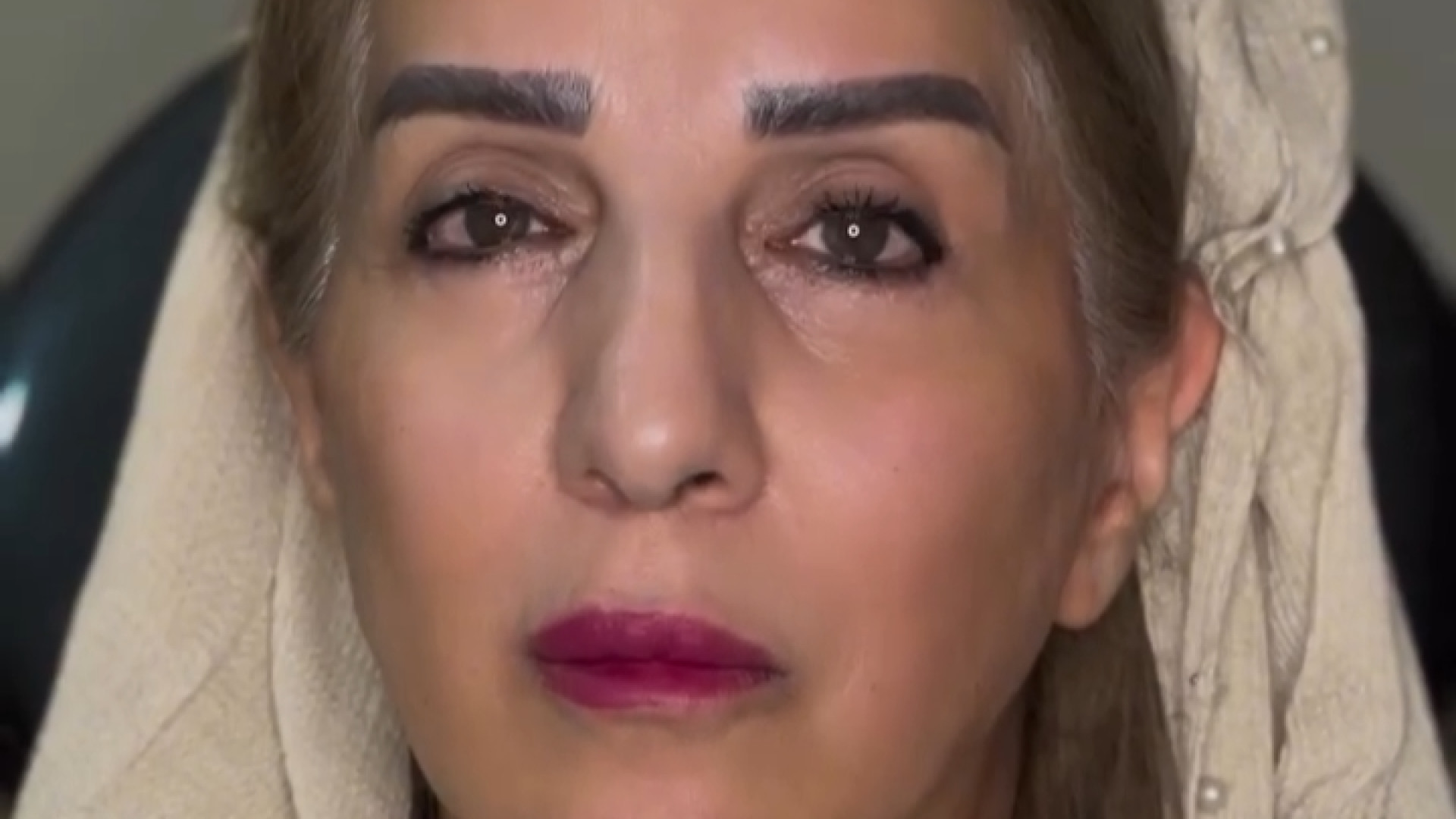 لیفت با نخ؛ جوان‌سازی بدون جراحی پلاستیک لثه