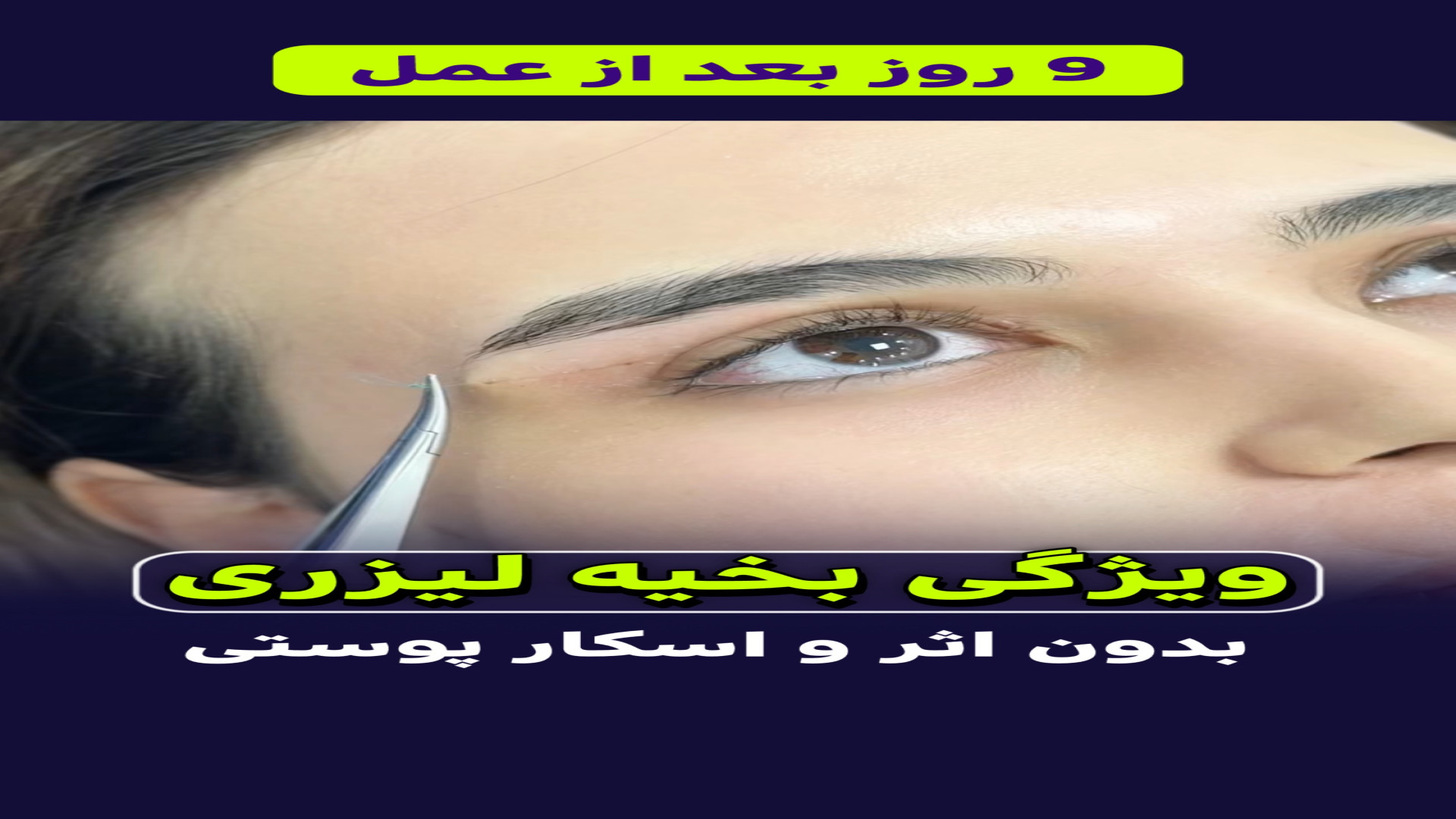ویژگی بخیه های لیزری در بلفاروپلاستی دیوید بکهام