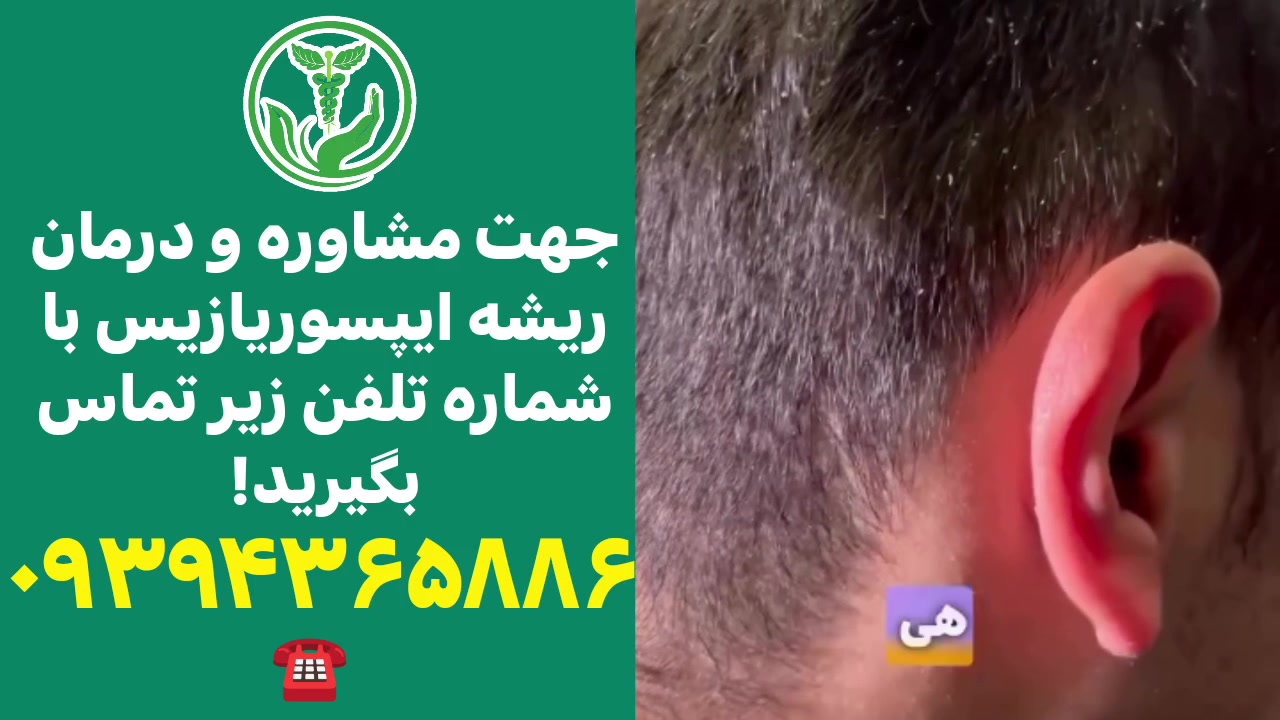 درمان ریشه ای پسوریازیس/09394365886 سیامک انصاری