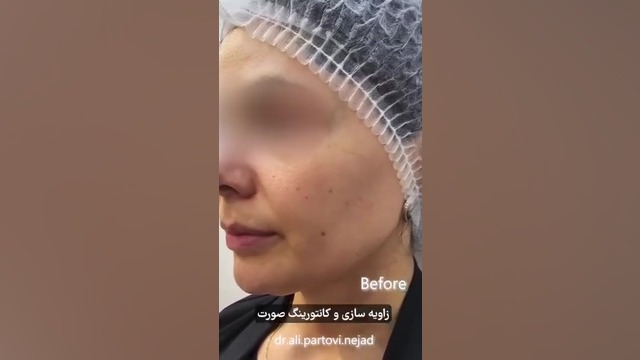 زاویه سازی و کانتورینگ صورت با تزریق فیلر توسط دکتر علی پرتوی نژاد دندان شیری