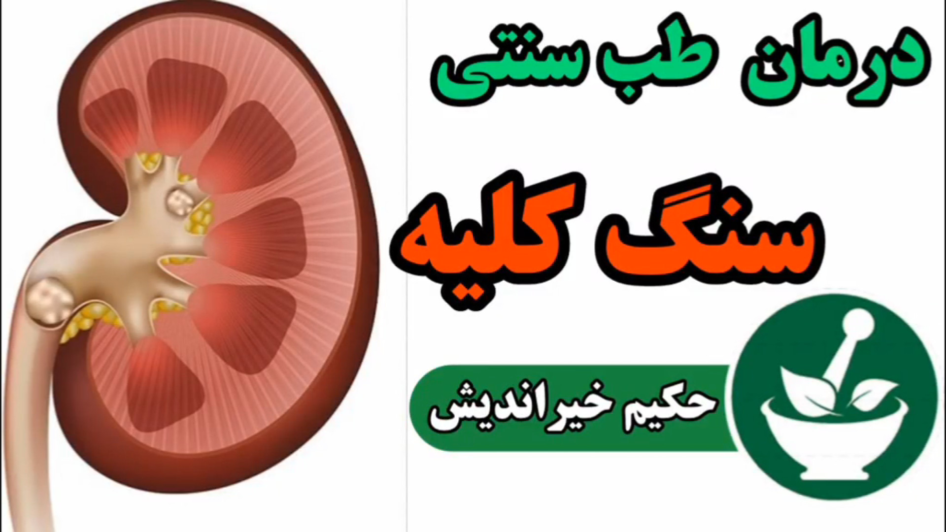 درمان سنگ کلیه بدون جراحی با نسخه‌های حکیم خیراندیش. تلفن:09366403577 پالپوتومی