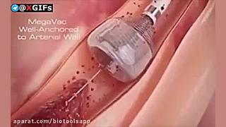 آنژیوگرافی بلیچینگ