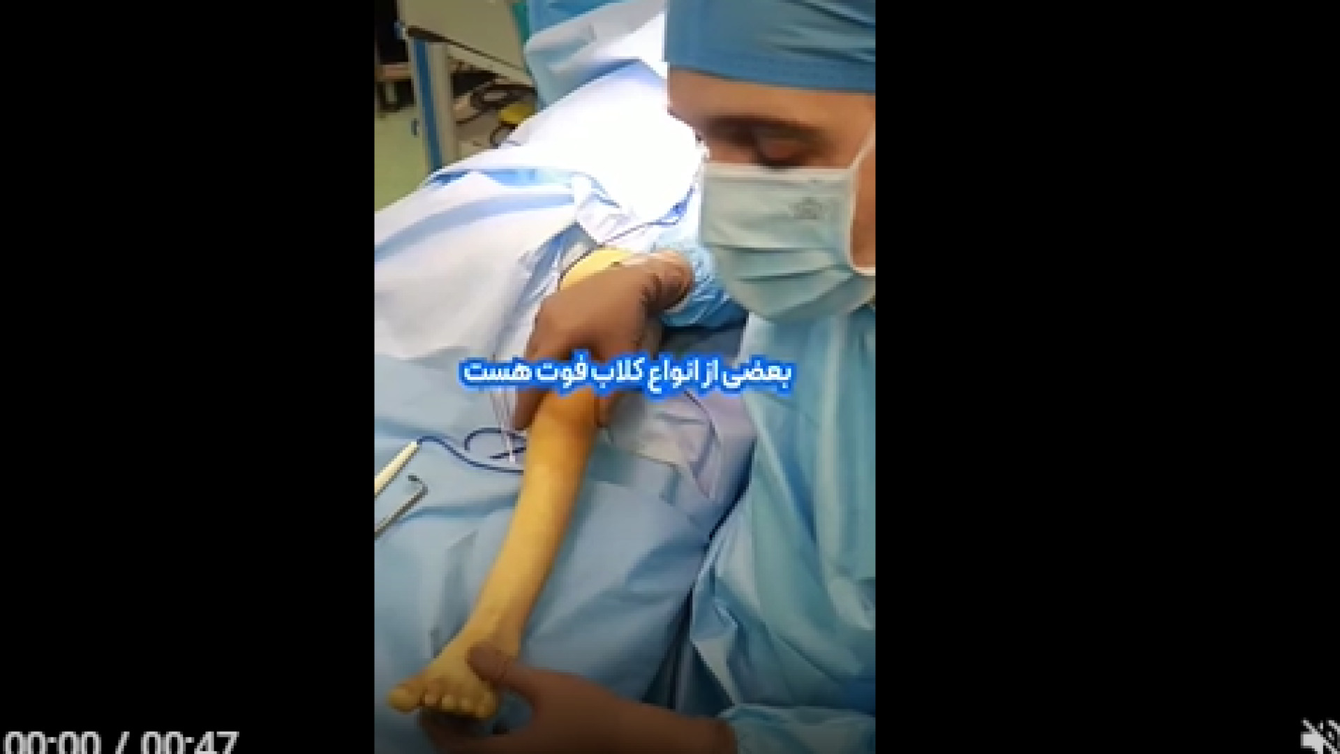 کلاب فوت پارالیتیک در کودکان حلزون تیک‌تاکی