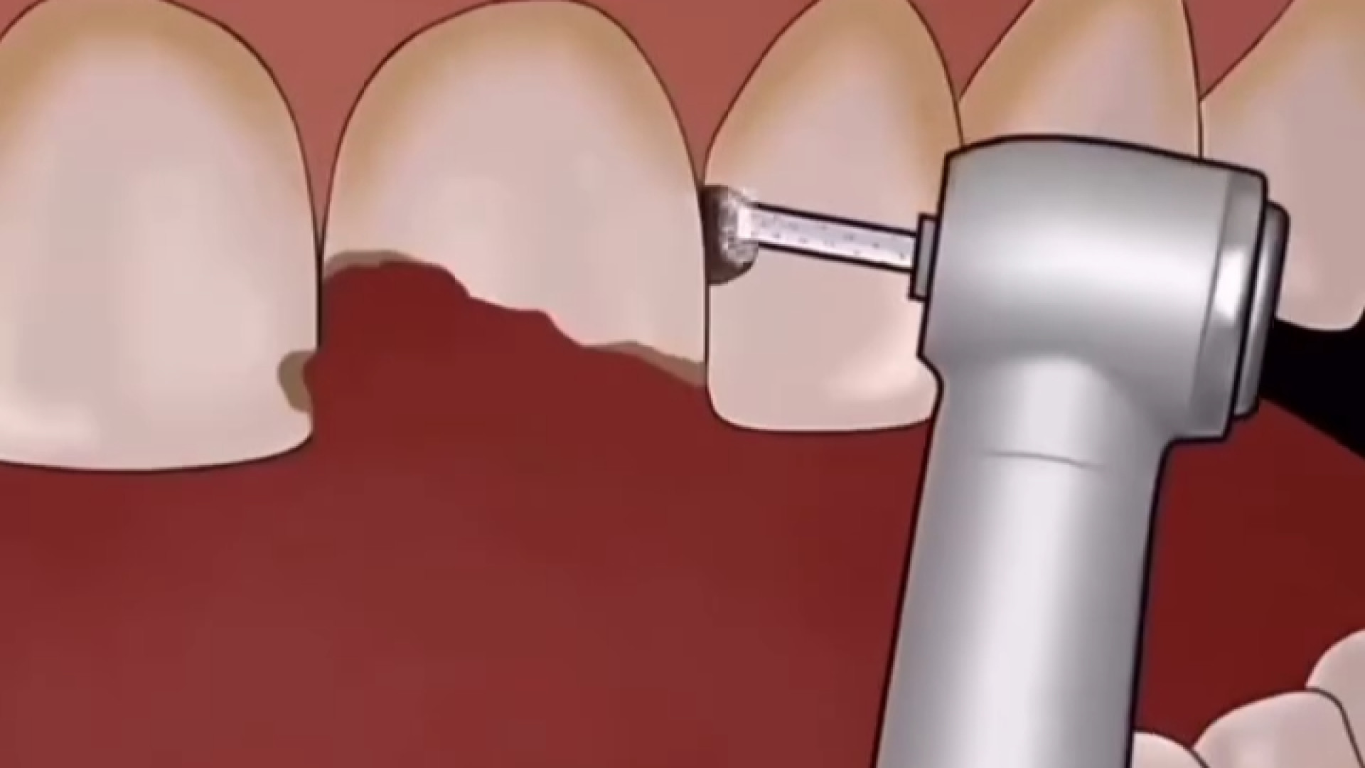 مراحل ترمیم و کامپوزیت دندان ایمونوانژیوگرافی