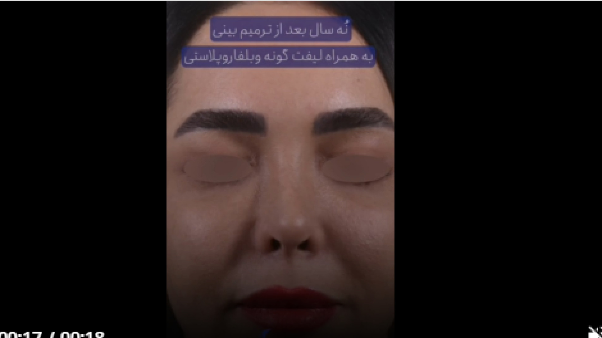 نه سال پس از ترمیم بینی ریمیکس