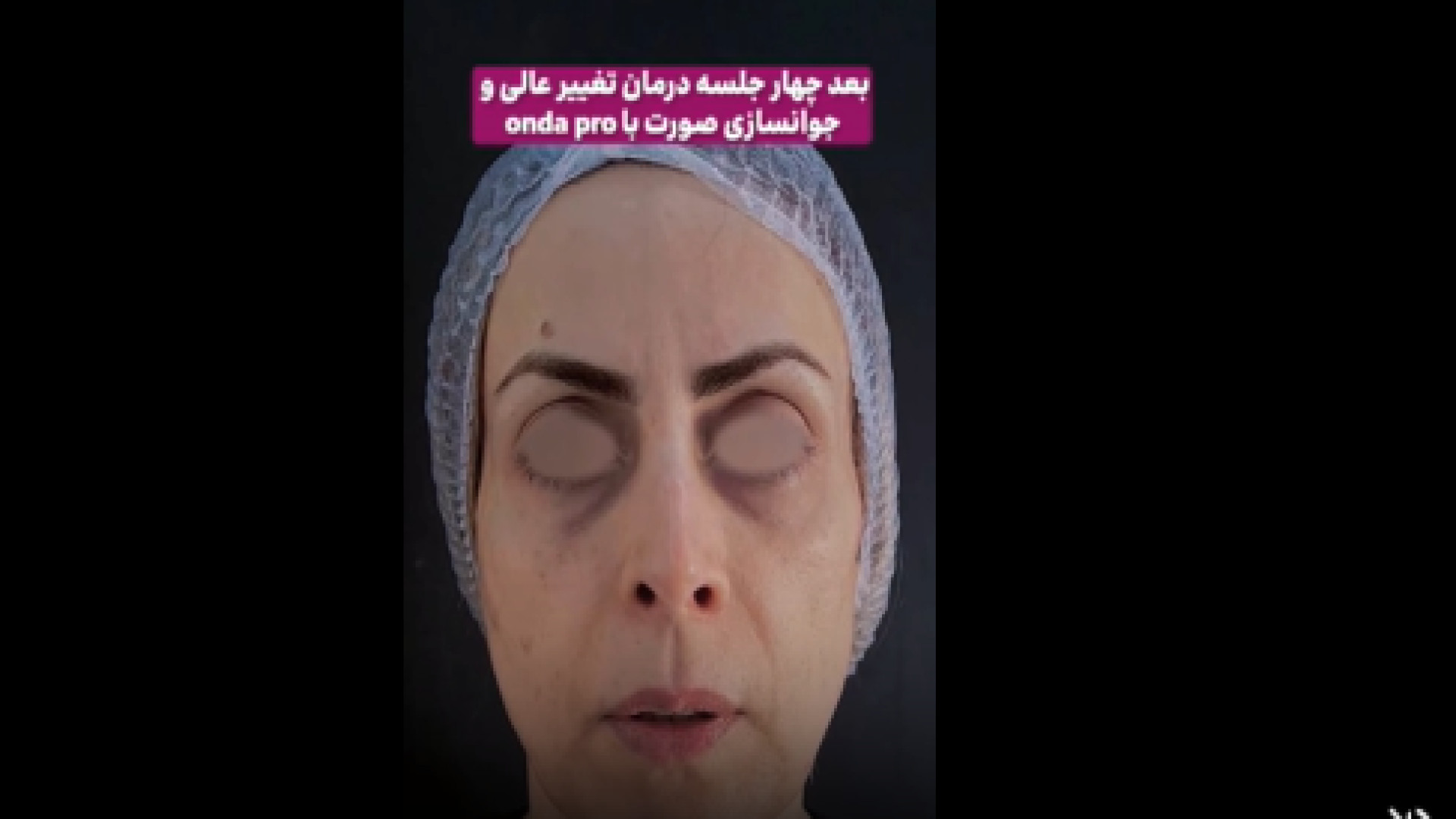 نتیجه لیفت صورت بدون جراحی فقط با اوندا پرو کلینیک مو