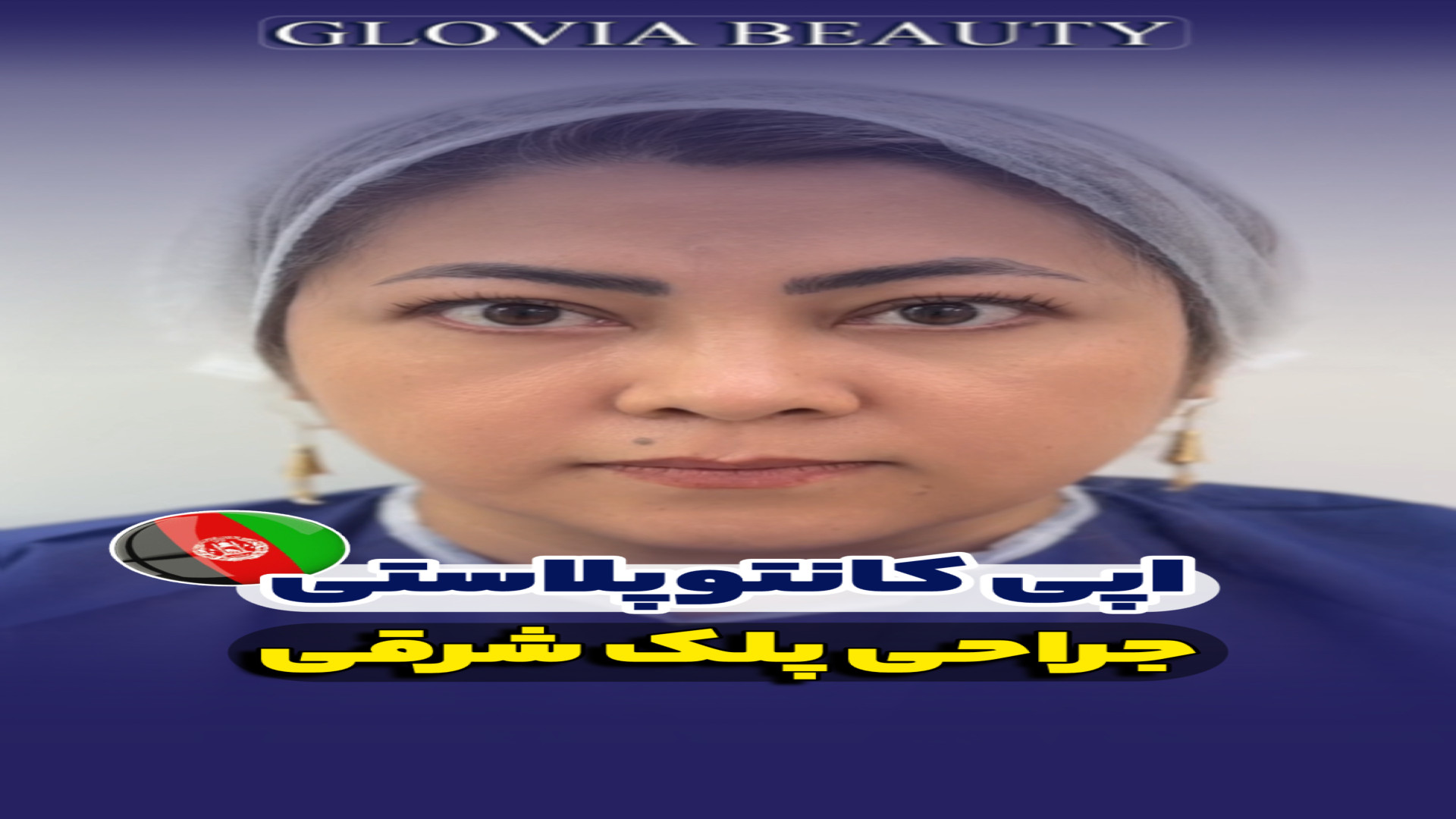 اپی کانتو پلاستی فریدون فروغی