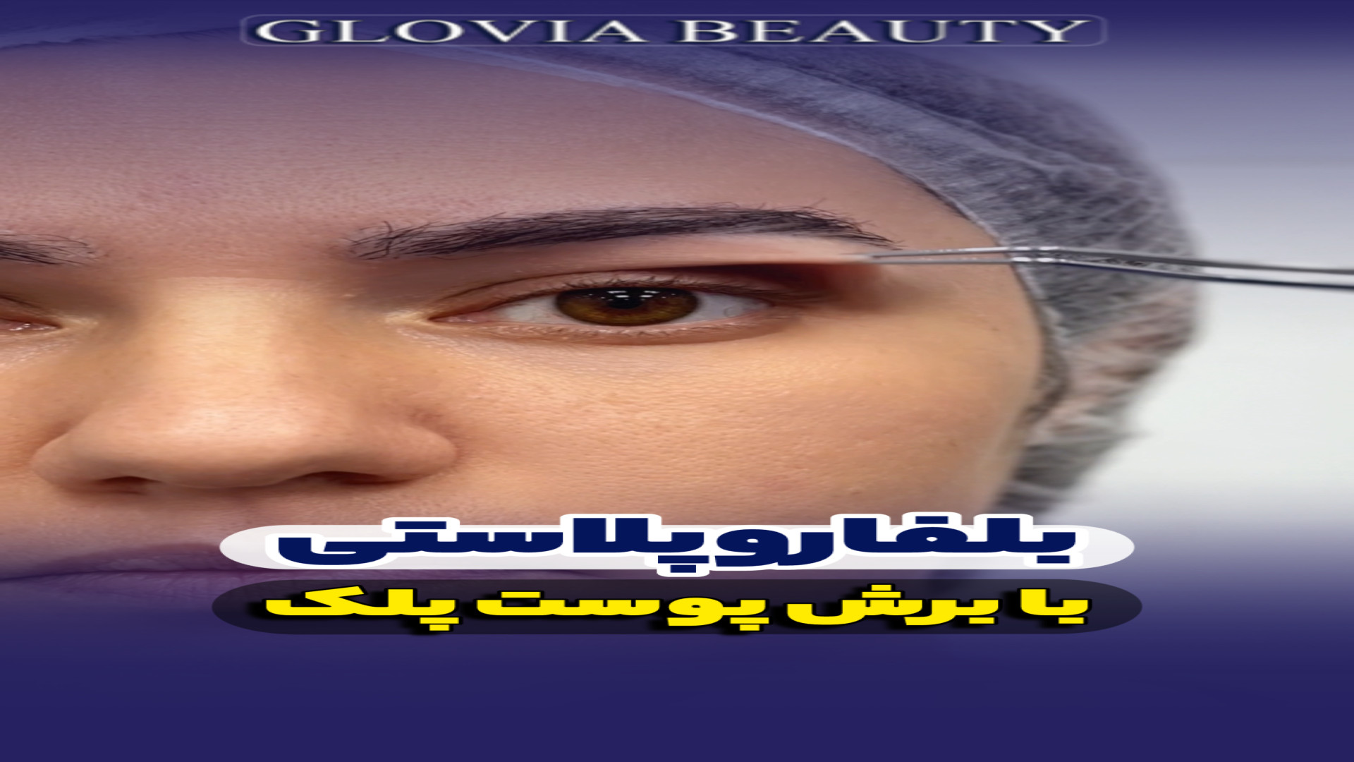 بلفاروپلاستی با برش پوست پلک دندان شیری